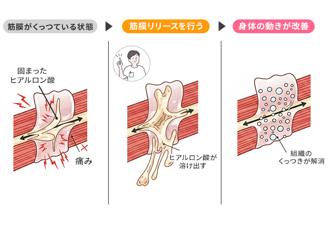 筋膜がくっついている状態⇒筋膜リリースを行う⇒身体の動きが改善